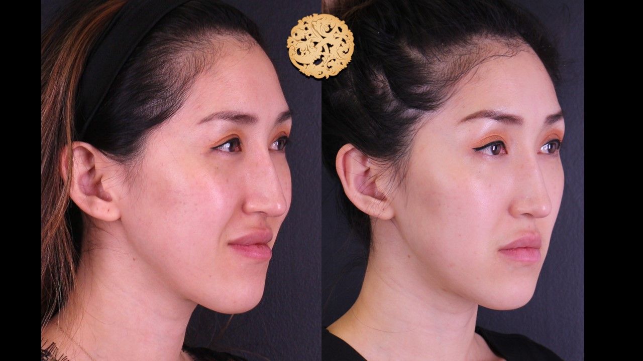 Vivace Before & After