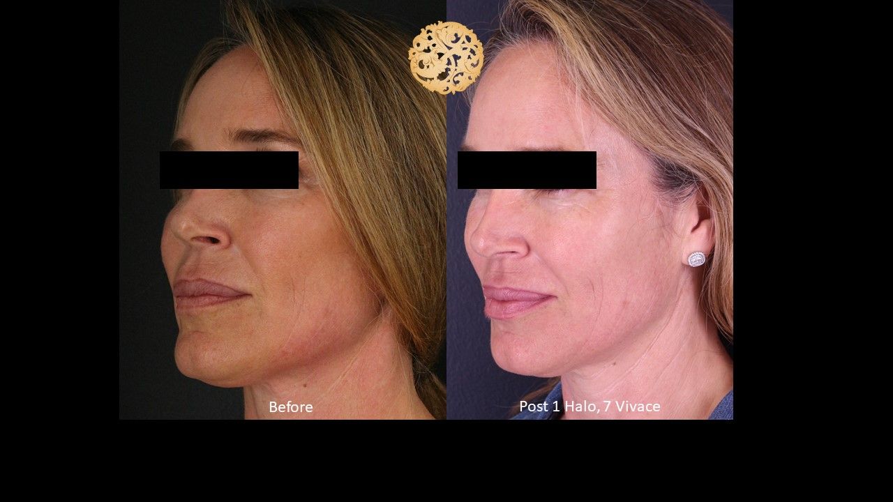 Vivace Before & After