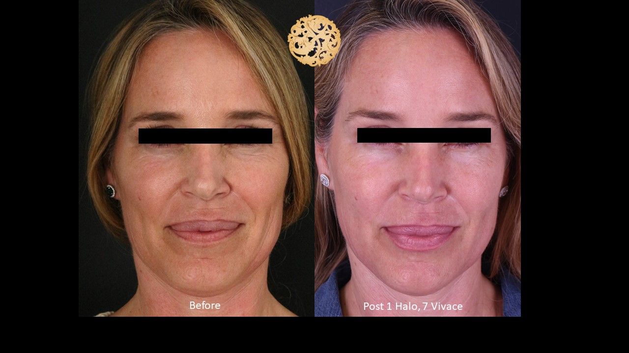 Vivace Before & After