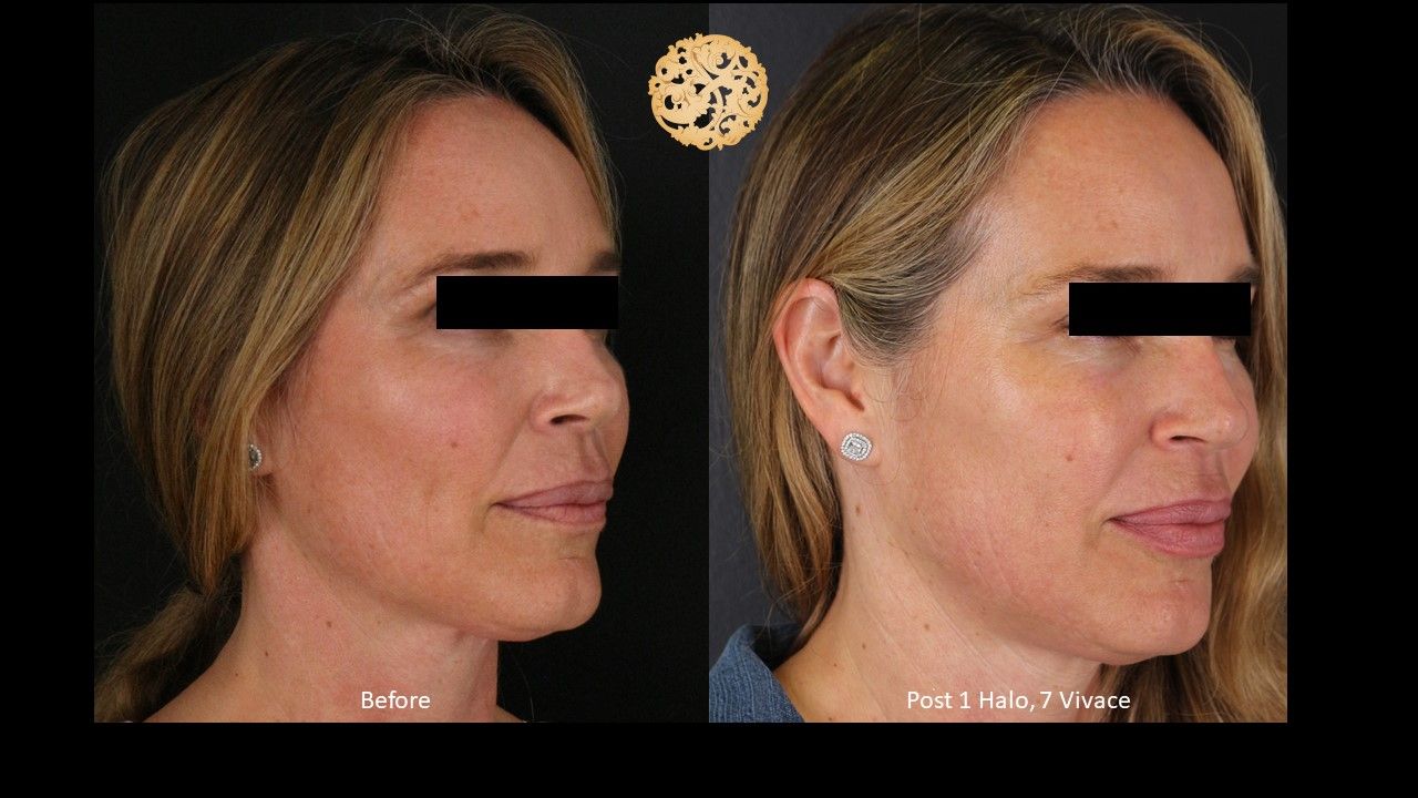 Vivace Before & After