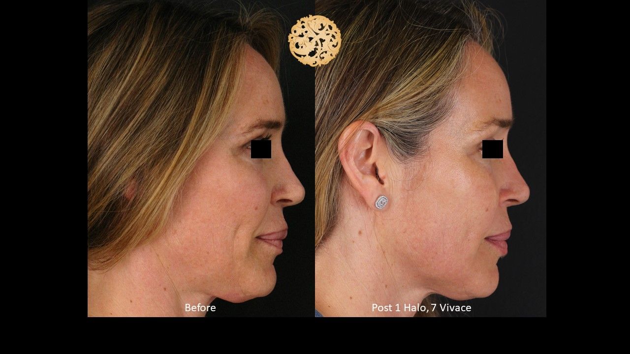 Vivace Before & After