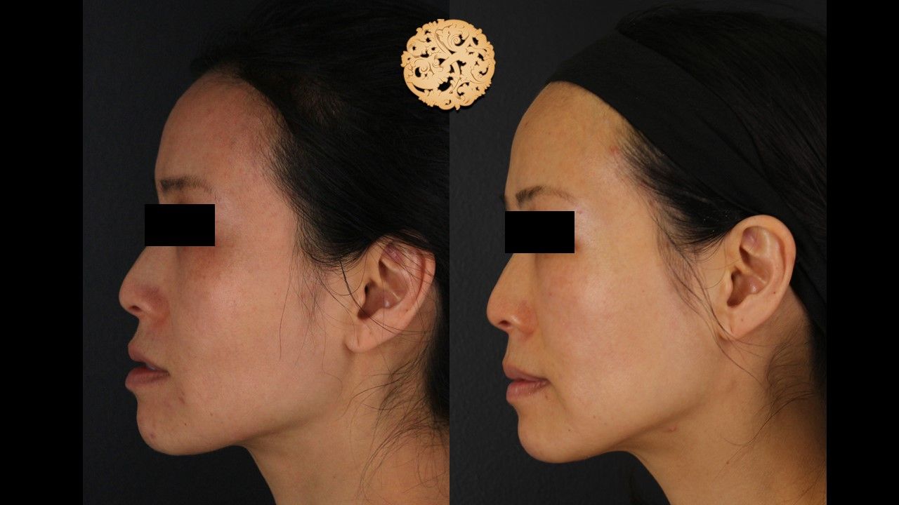 Vivace Before & After