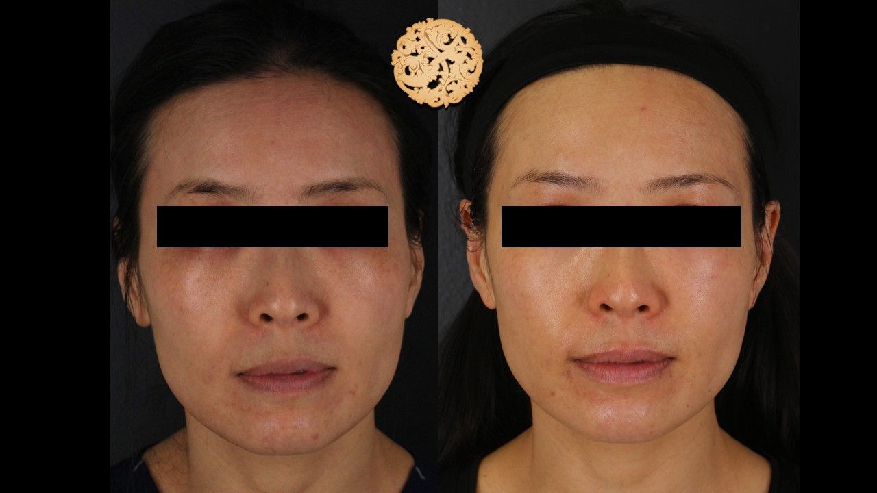 Vivace Before & After