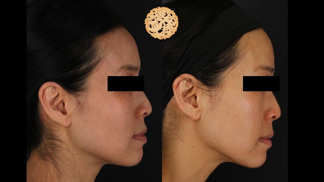 Vivace Before & After