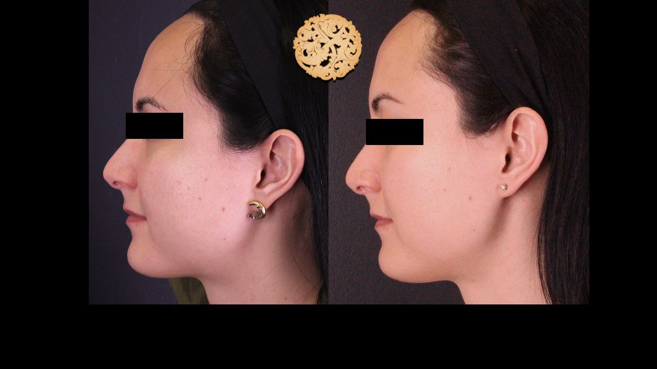 Vivace Before & After