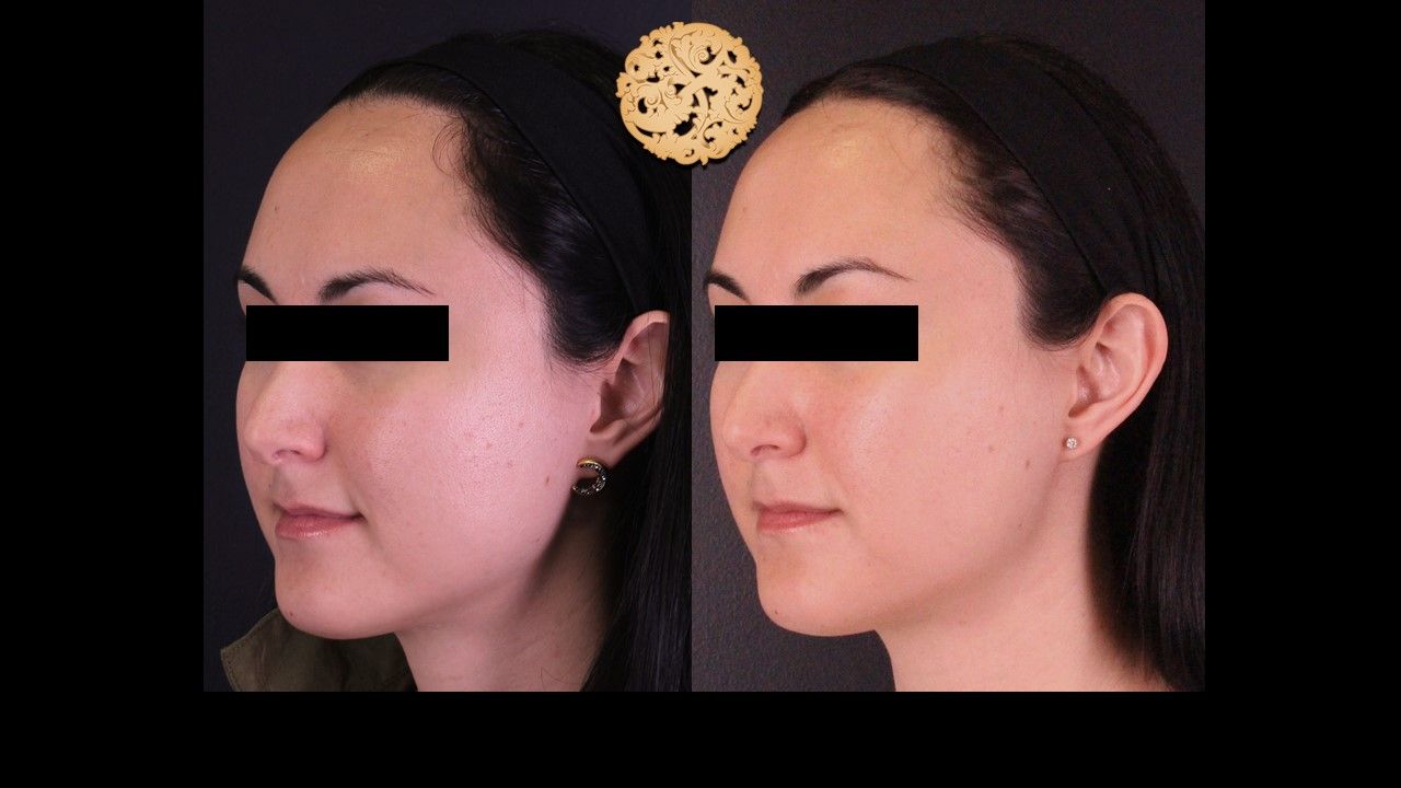 Vivace Before & After