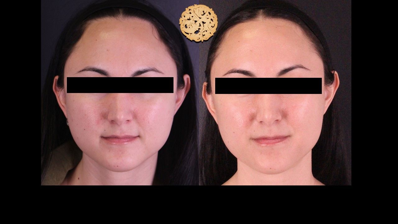 Vivace Before & After