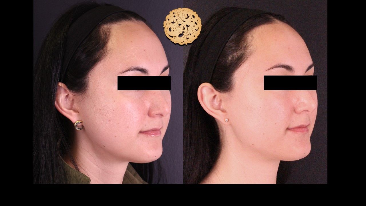 Vivace Before & After