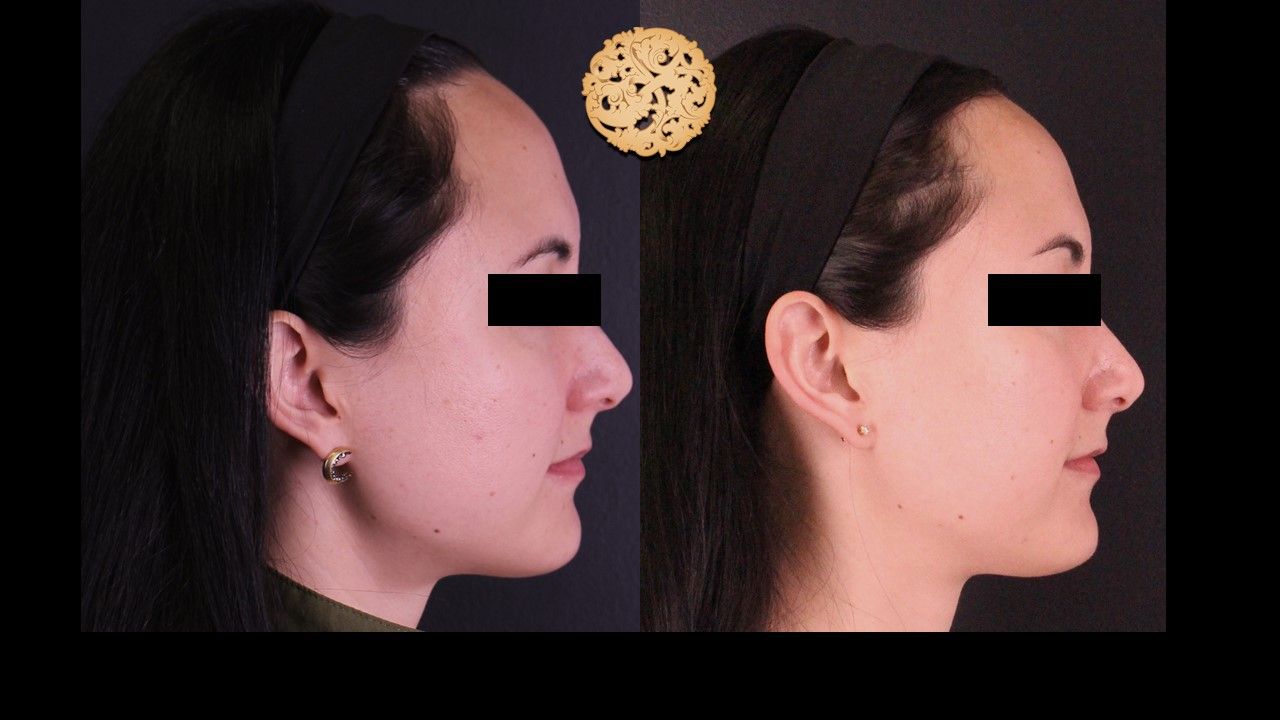 Vivace Before & After