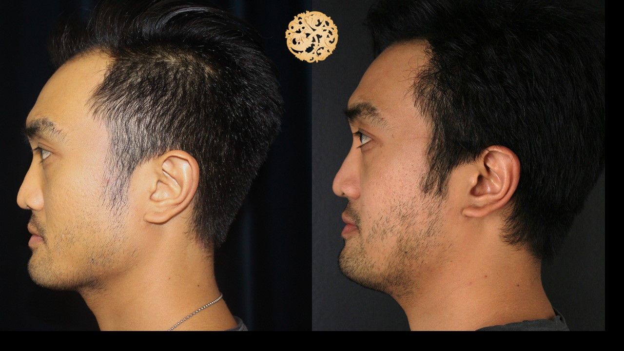 Vivace Before & After