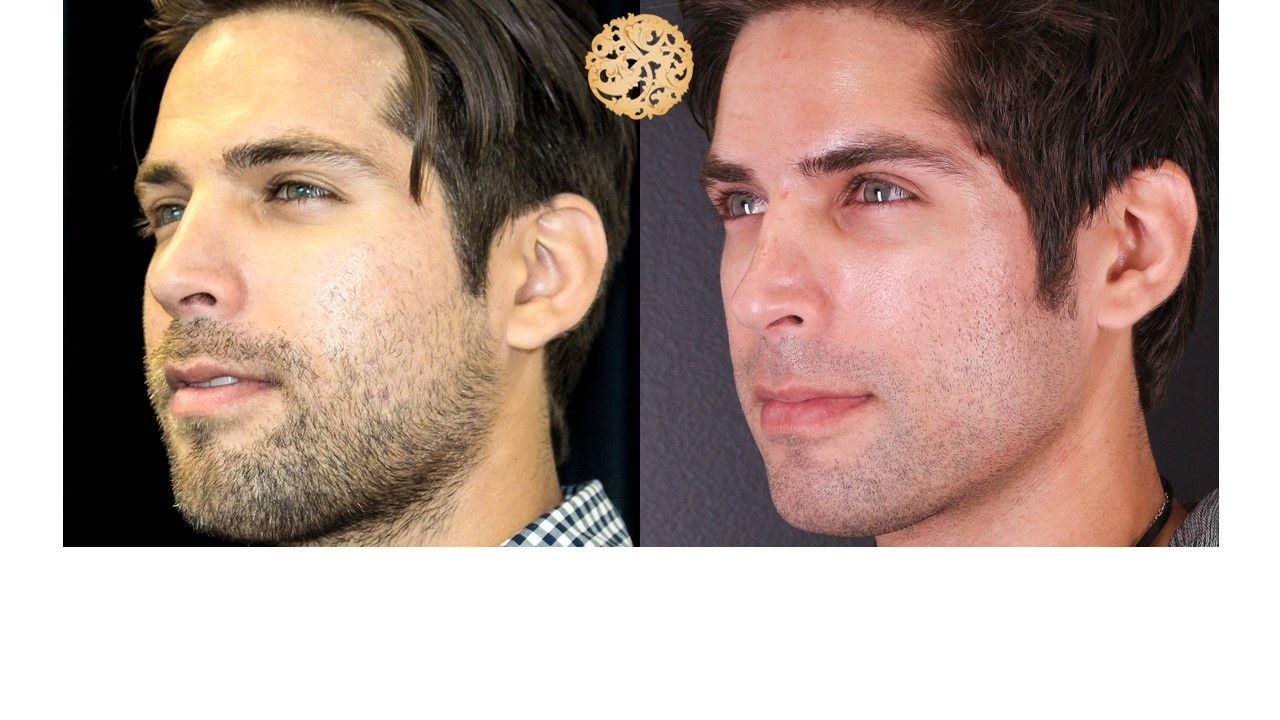 Vivace Before & After