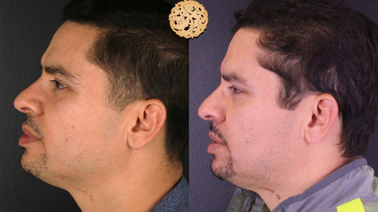 Vivace Before & After