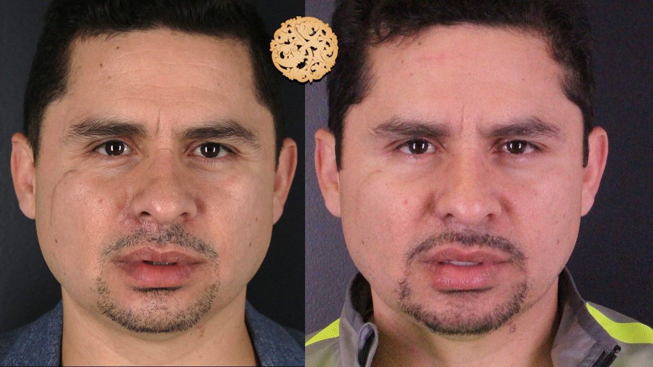 Vivace Before & After