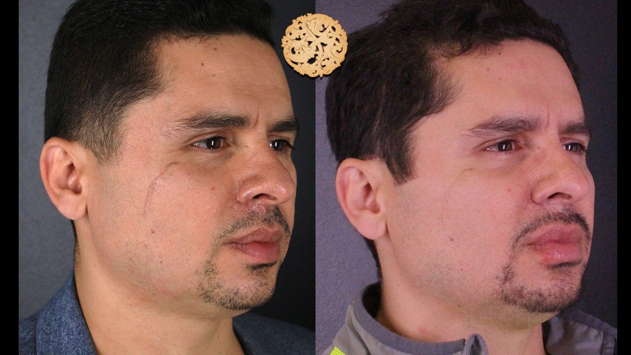 Vivace Before & After