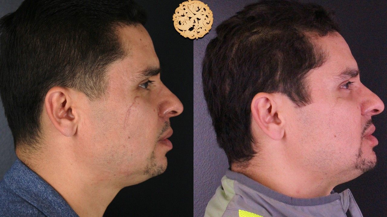 Vivace Before & After