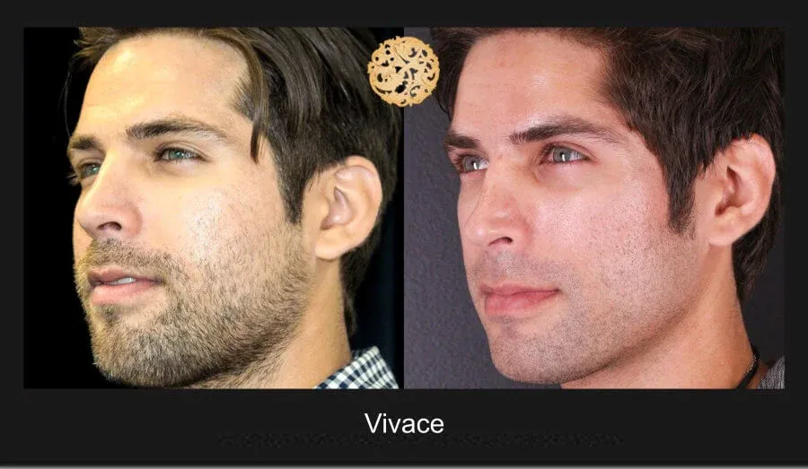 Vivace Before & After