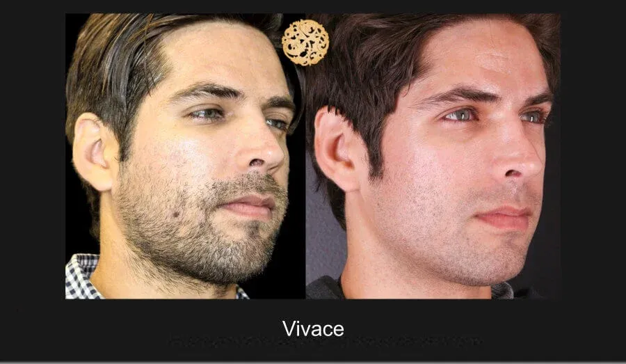 Vivace Before & After