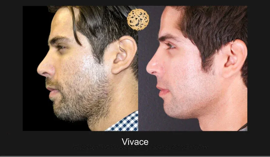 Vivace Before & After