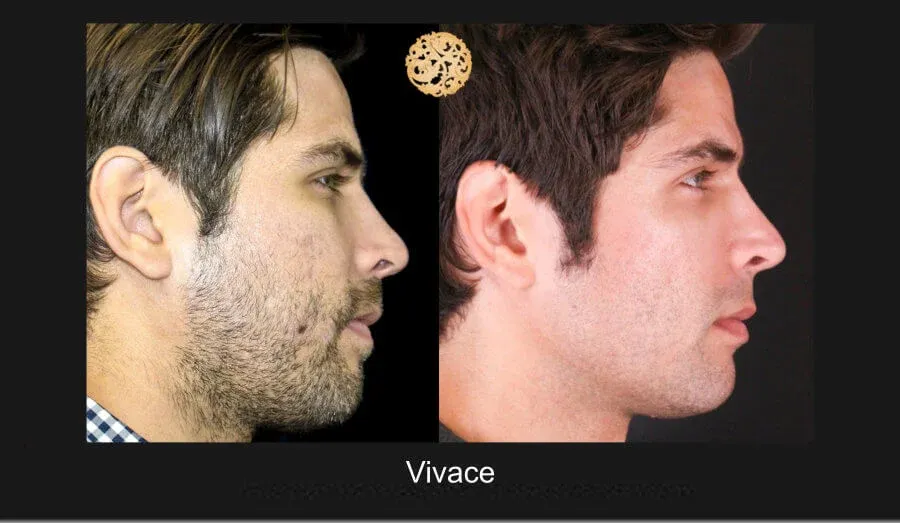 Vivace Before & After