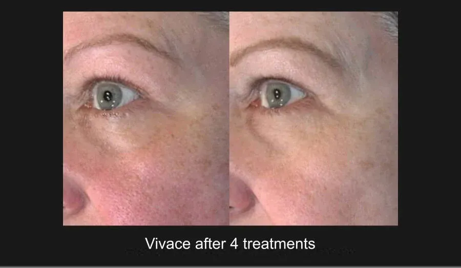 Vivace Before & After