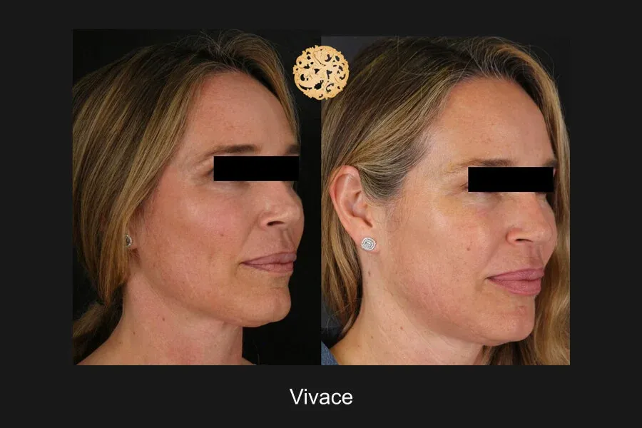 Vivace Before & After