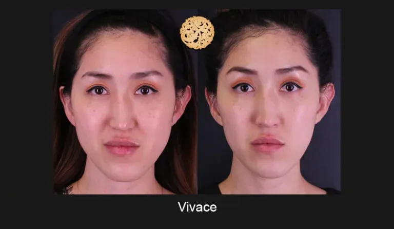 Vivace Before & After