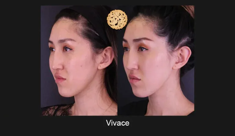Vivace Before & After
