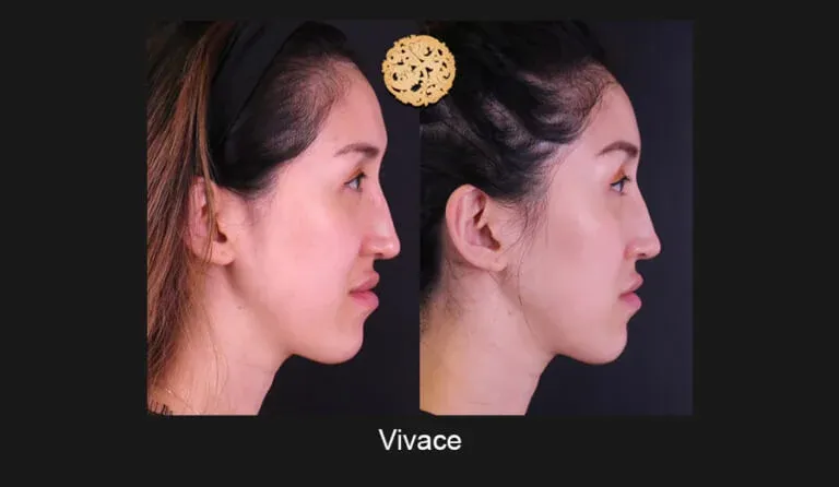 Vivace Before & After