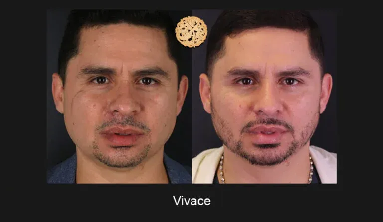 Vivace Before & After