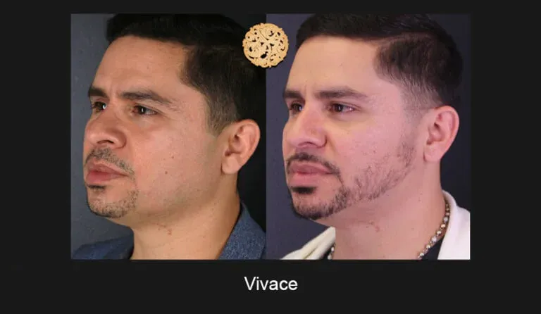 Vivace Before & After