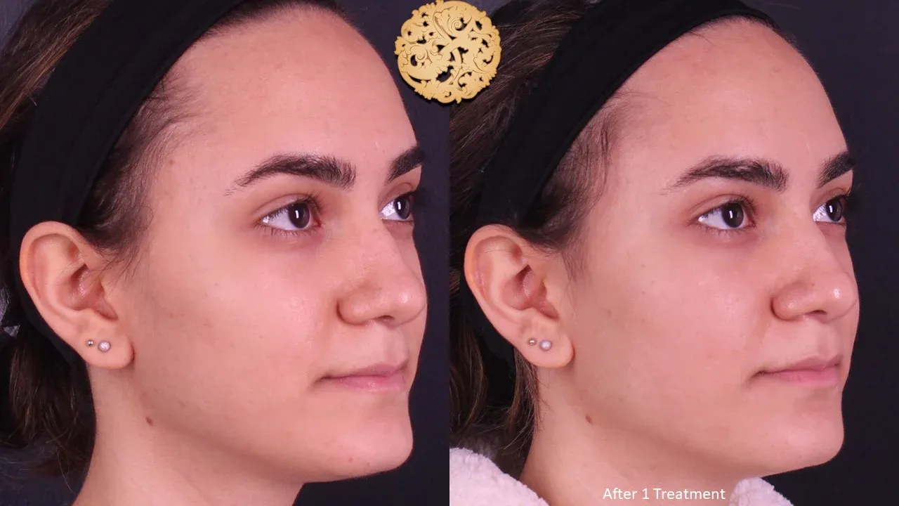 Vivace Before & After