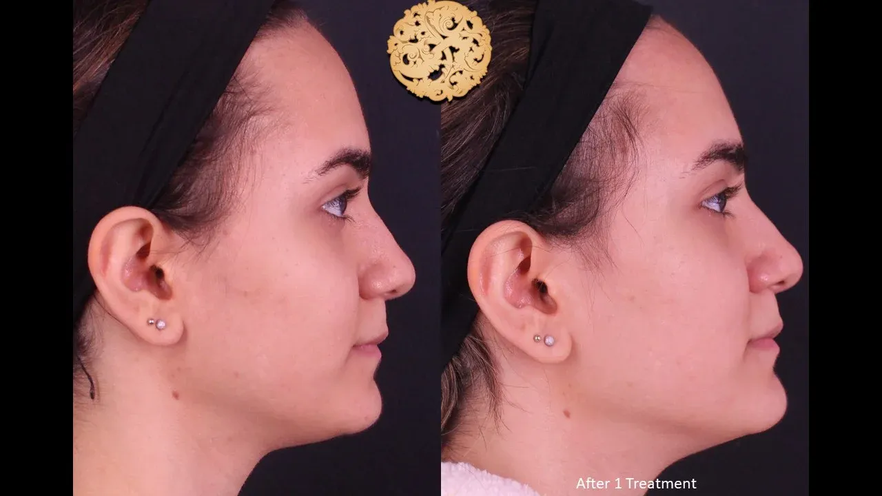 Vivace Before & After