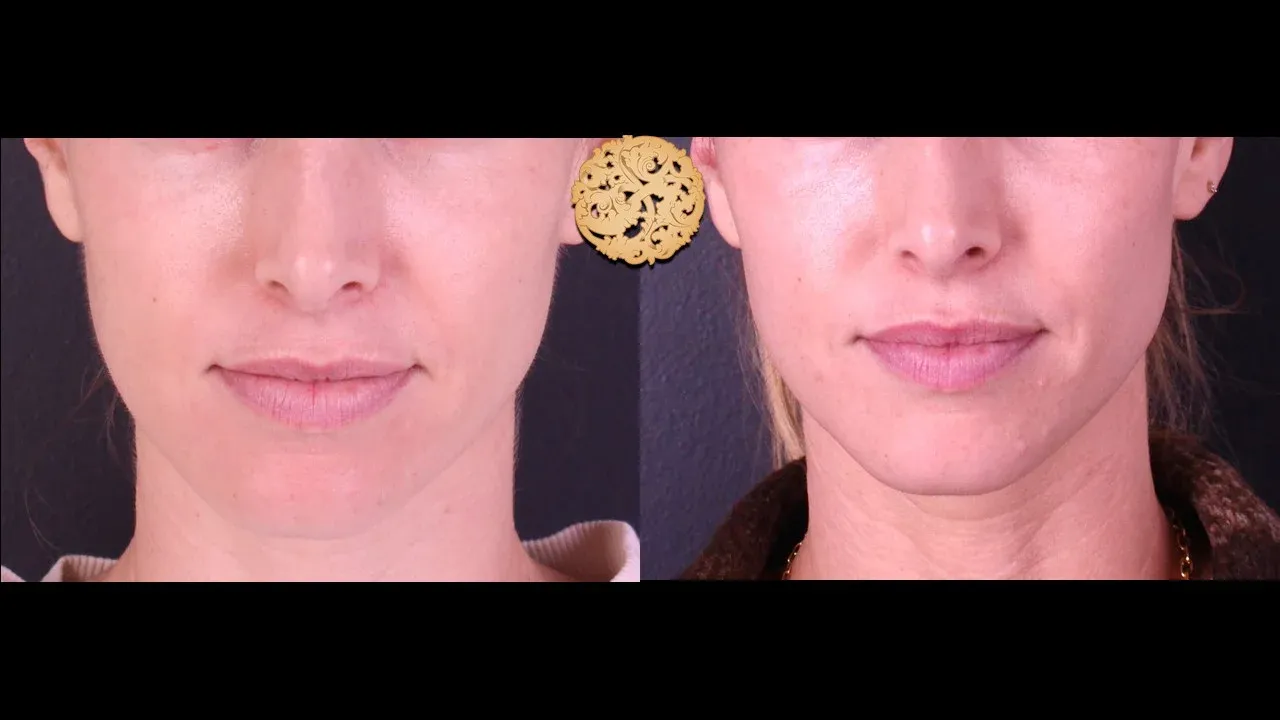 Vivace Before & After