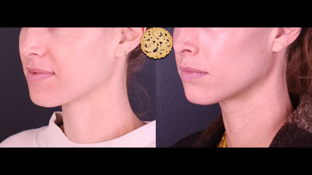 Vivace Before & After