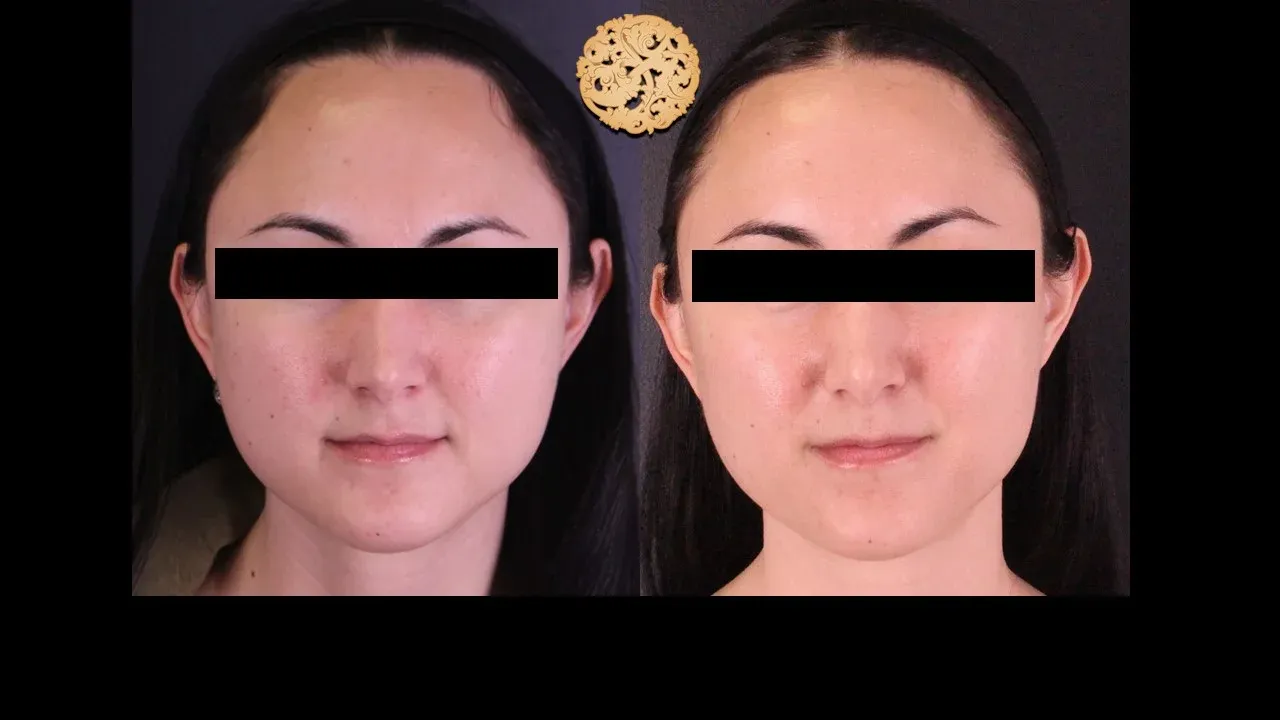 Vivace Before & After