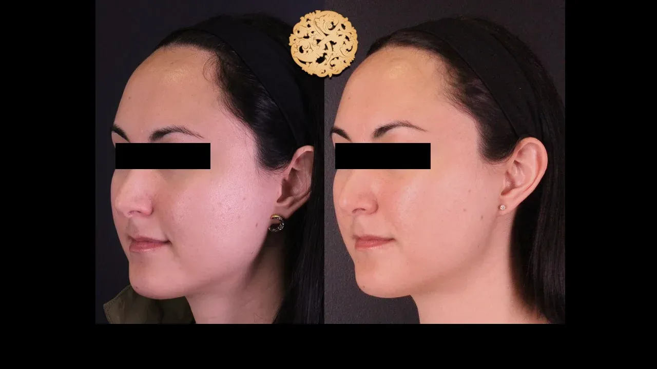 Vivace Before & After