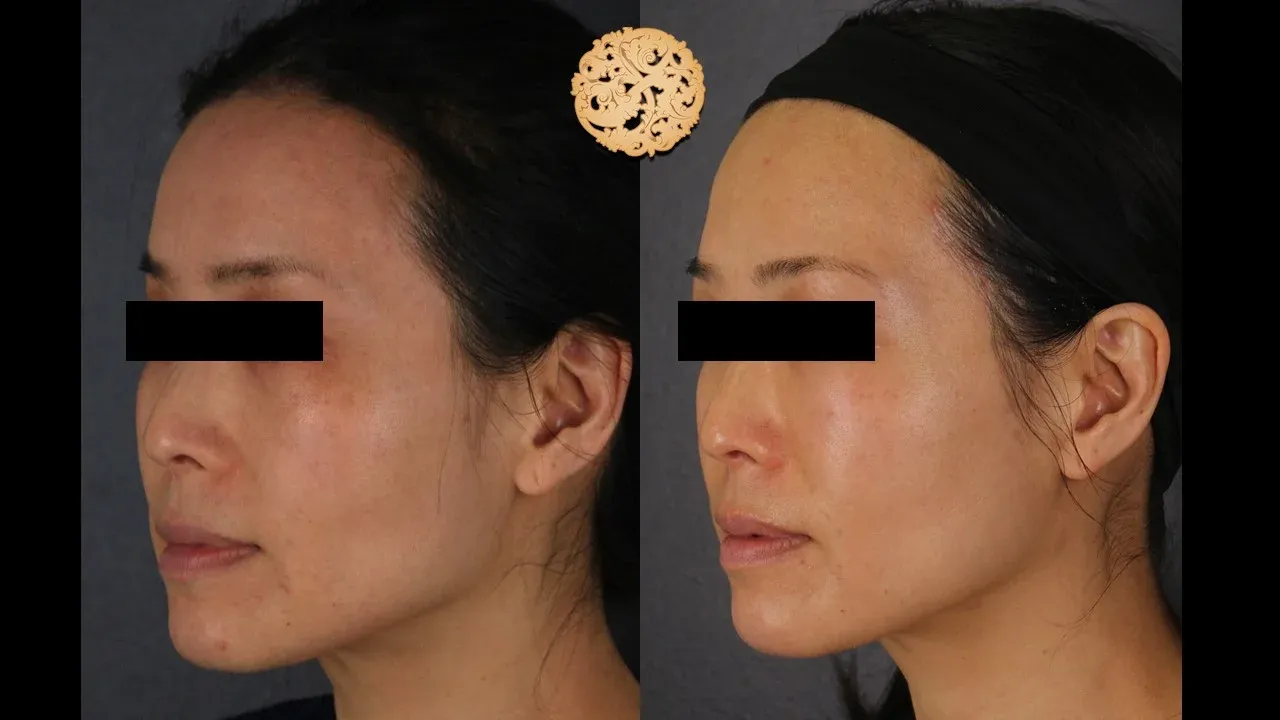 Vivace Before & After