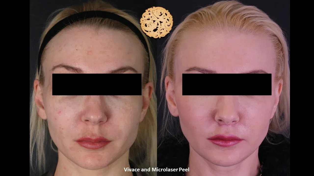 Vivace Before & After