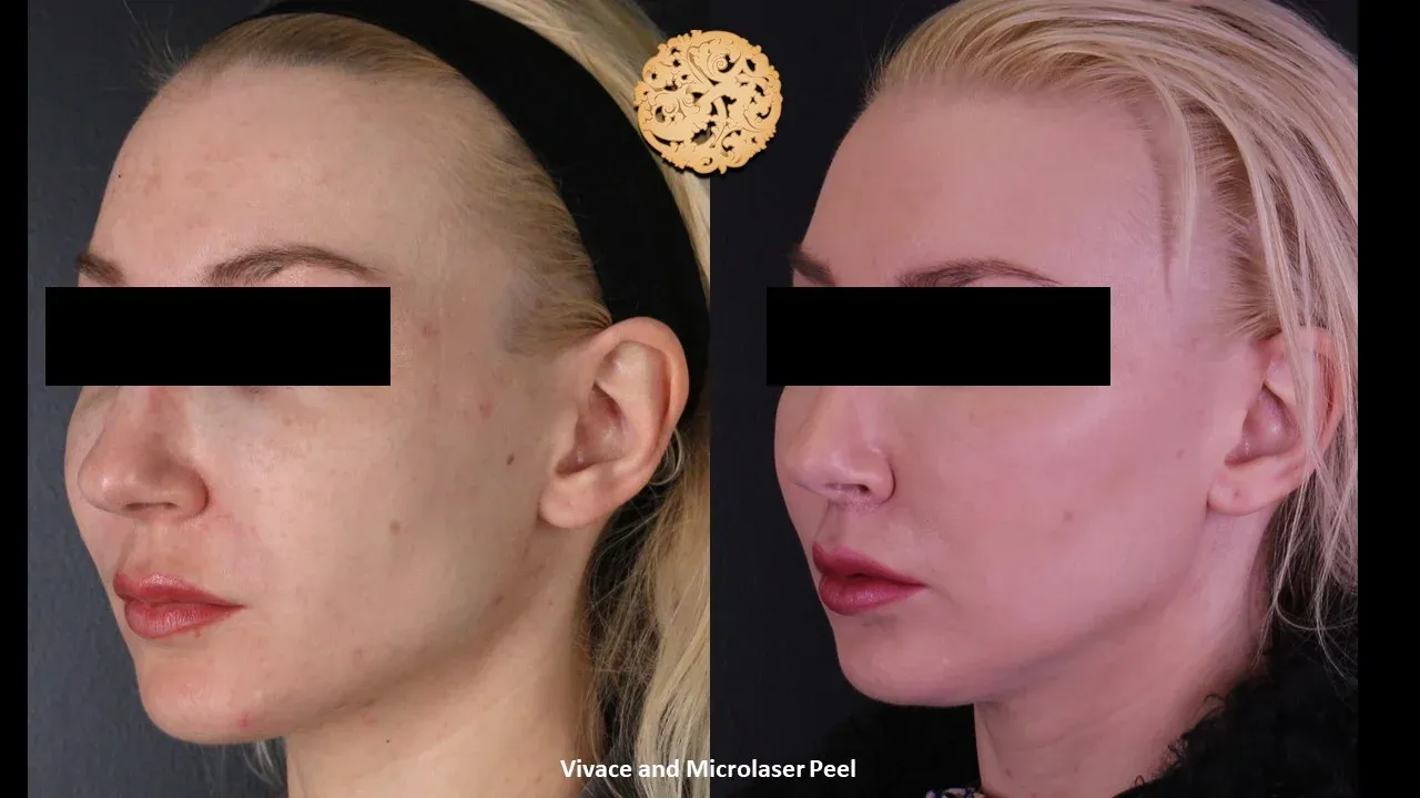 Vivace Before & After