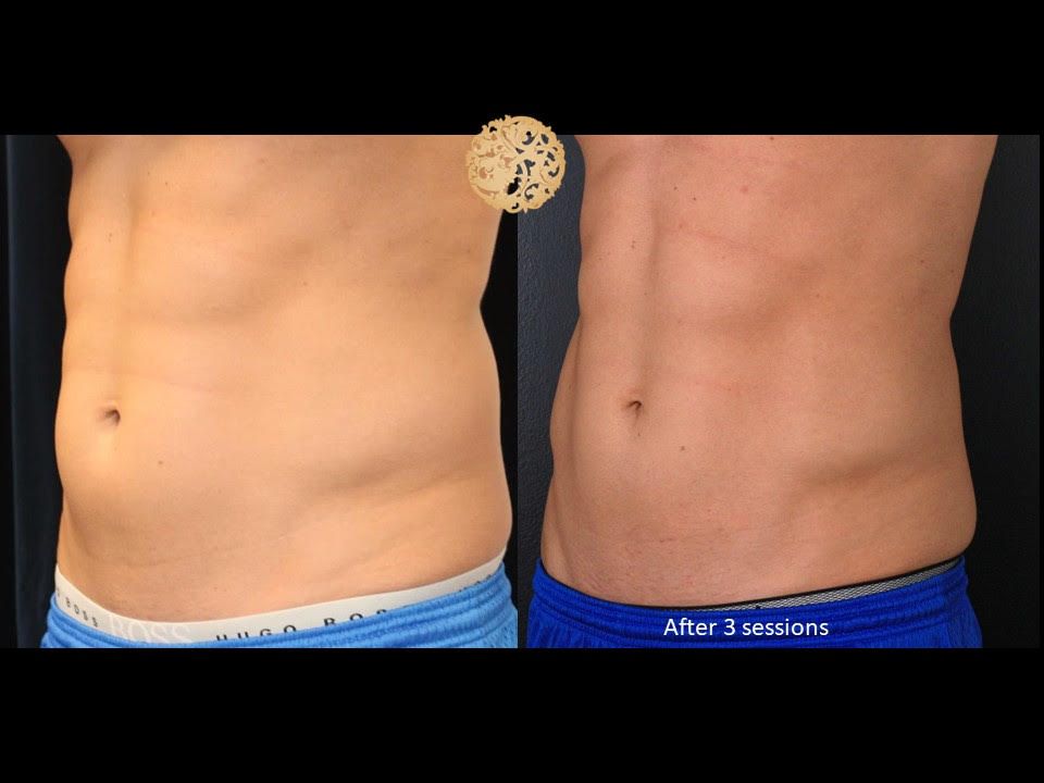 Fat Reduction Before & After