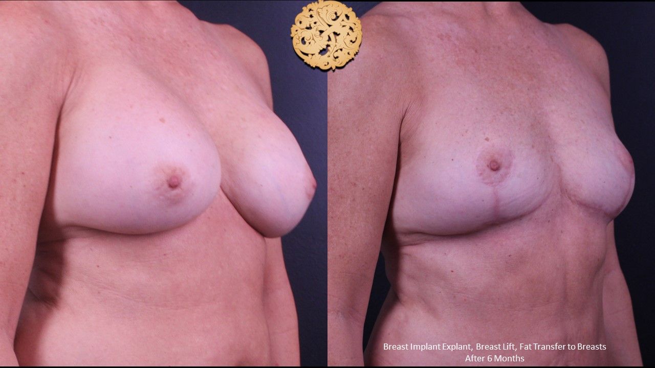 Breast Implant Removal Before & After