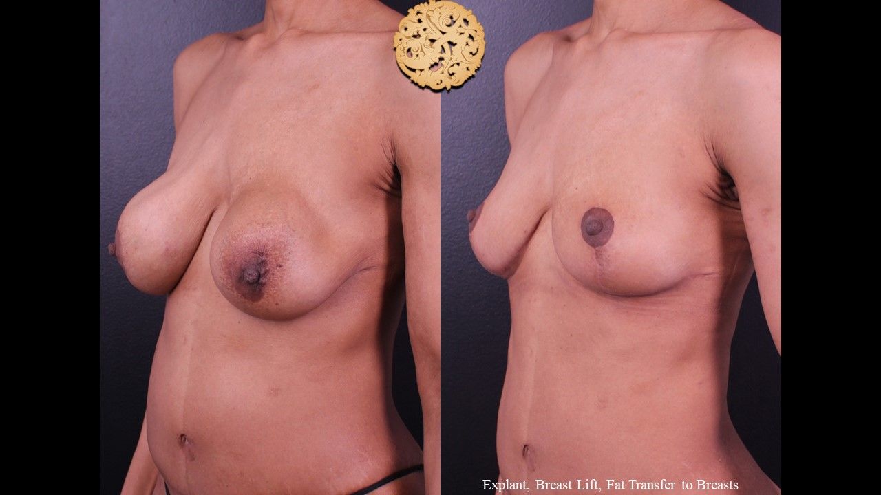 Breast Implant Removal Before & After