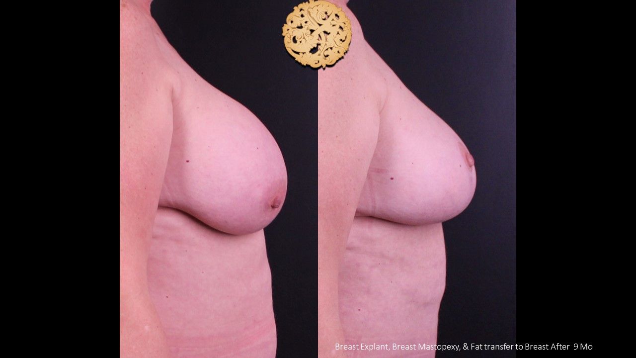 Breast Implant Removal Before & After