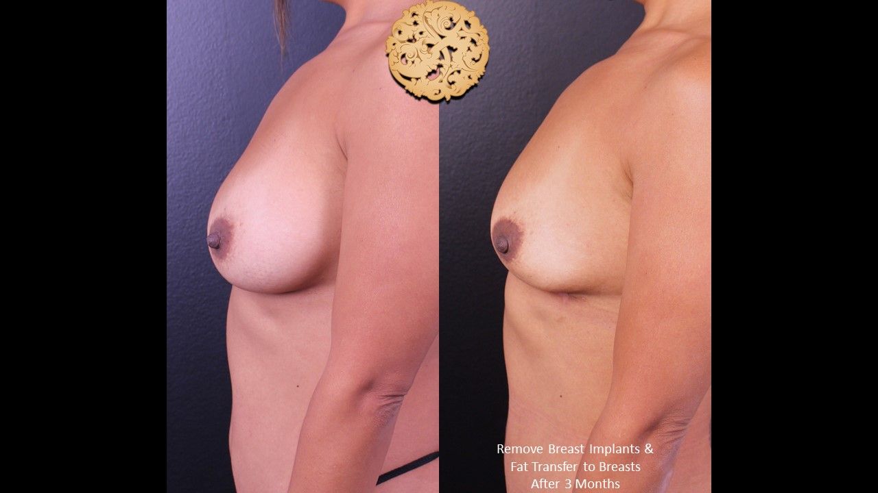 Breast Implant Removal Before & After