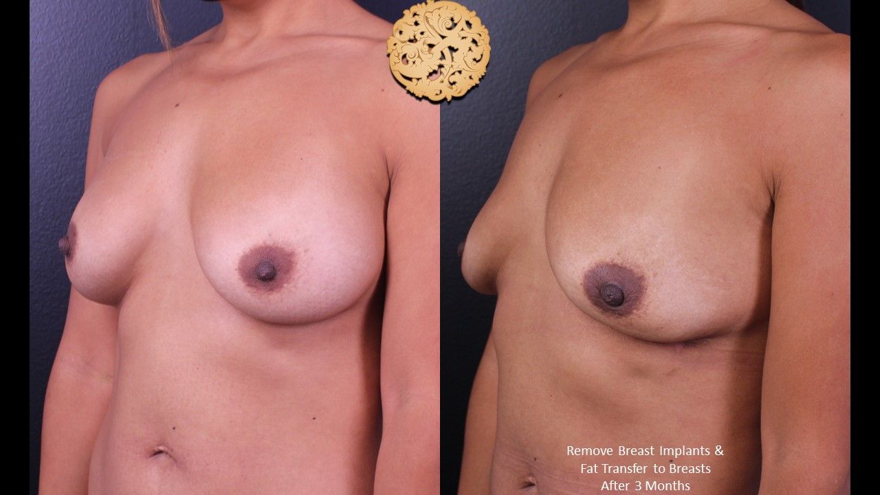 Breast Implant Removal Before & After