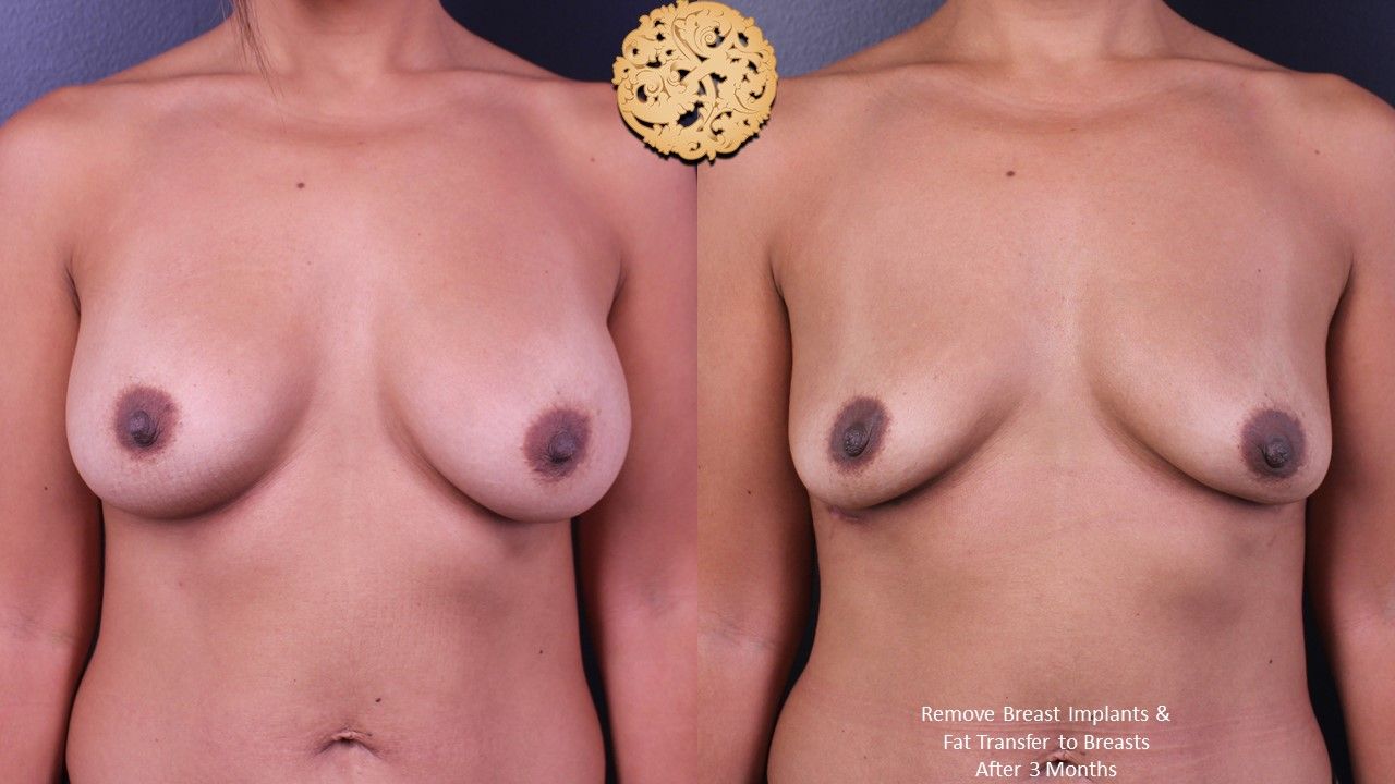 Breast Implant Removal Before & After
