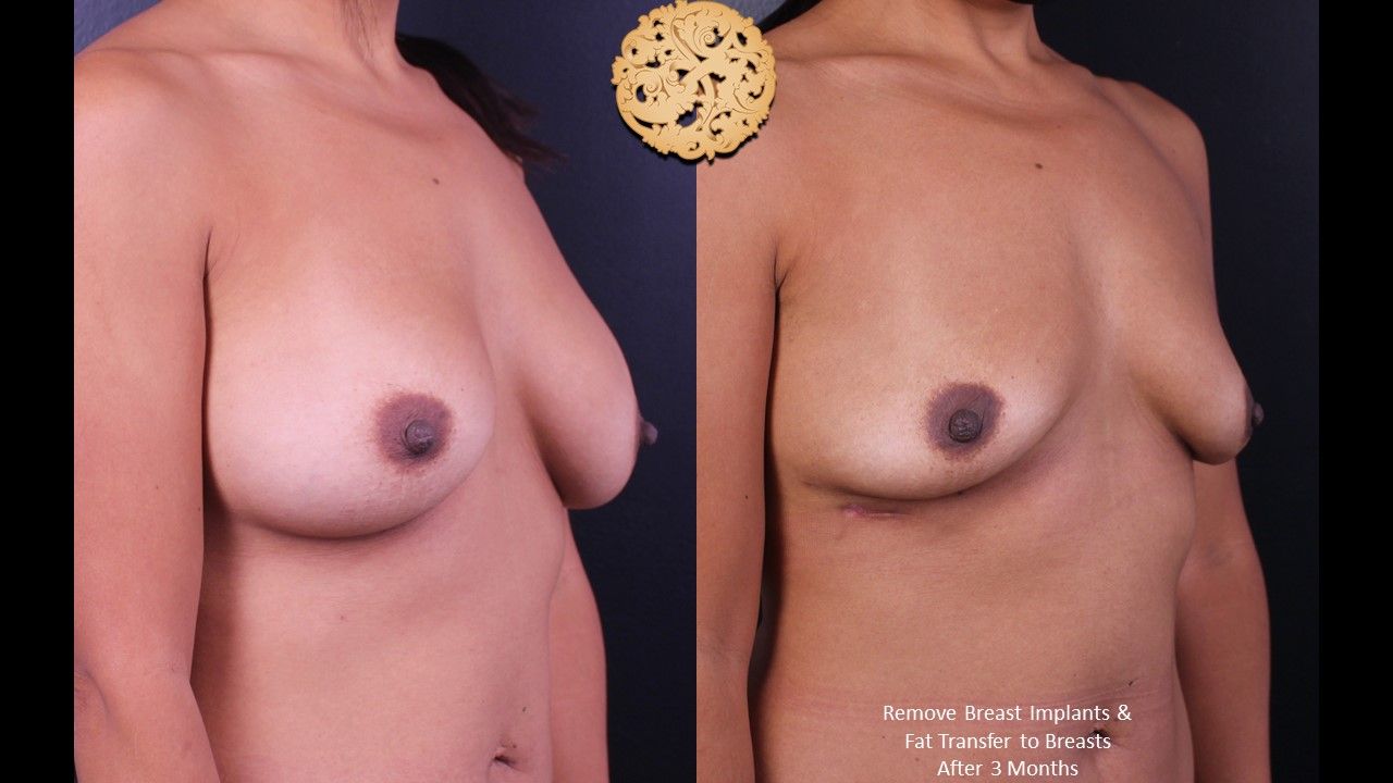 Breast Implant Removal Before & After