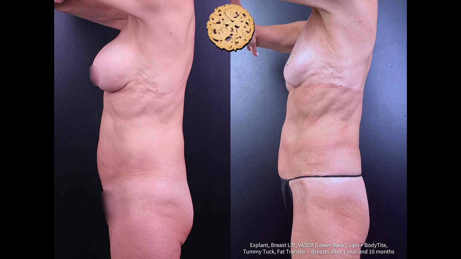 Breast Explant (Implant Removal) Before & After