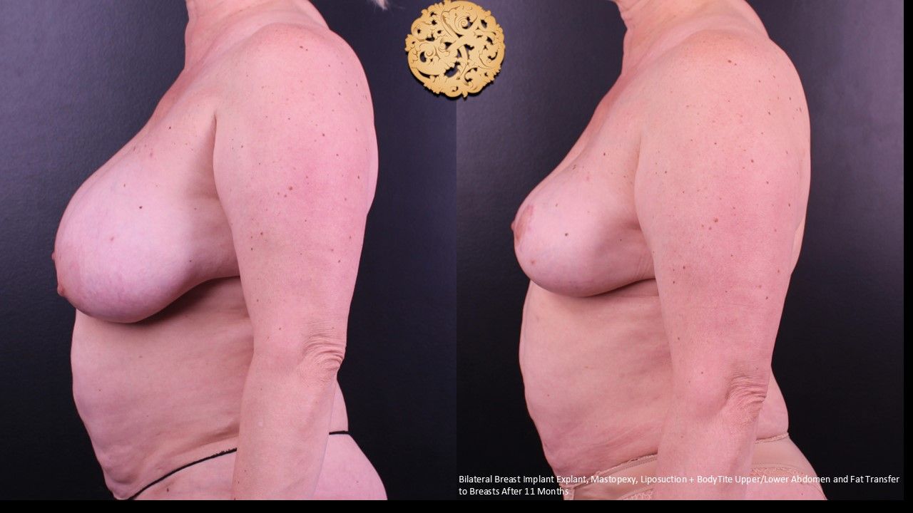 Breast Implant Removal Before & After