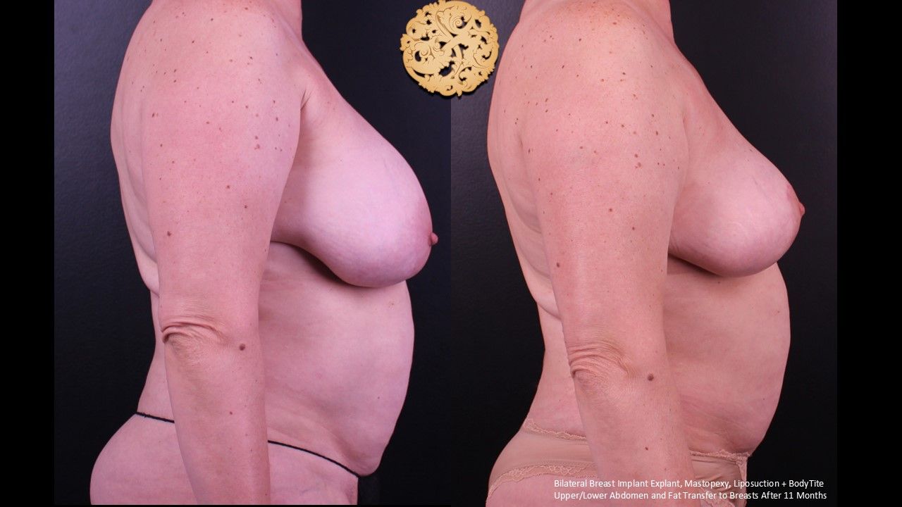 Breast Implant Removal Before & After